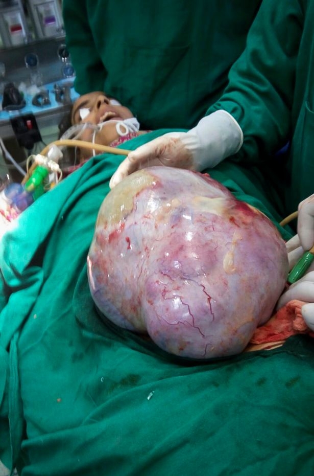 18岁少女肚子痛到崩溃,医生竟从她的卵巢拿出22公斤的「某种东西」