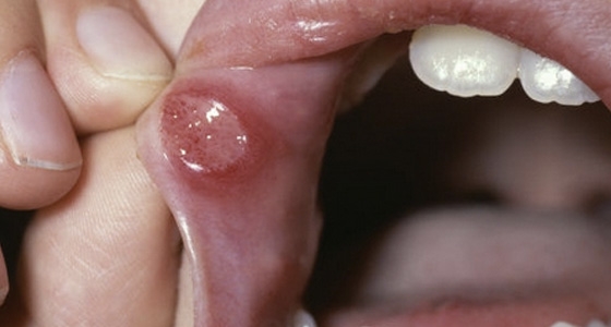 口腔溃烂有救了! 你绝对想不到~将这两样配著吃,竟然可以降肝火!