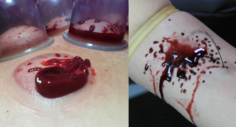 拔罐拔出一坨淤血图片
