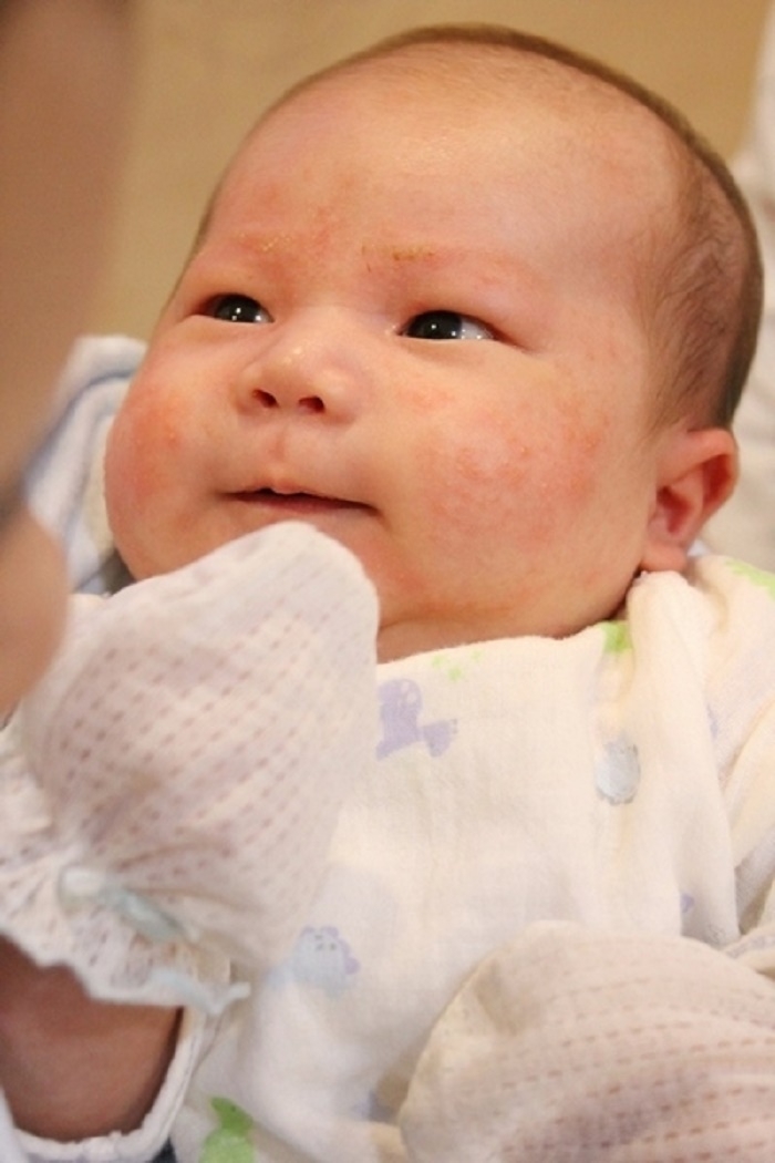 Life生活網 小寶寶也會長痘痘 談 嬰兒脂漏性皮膚炎 這個時期最容易發生 10個居家照護注意事項