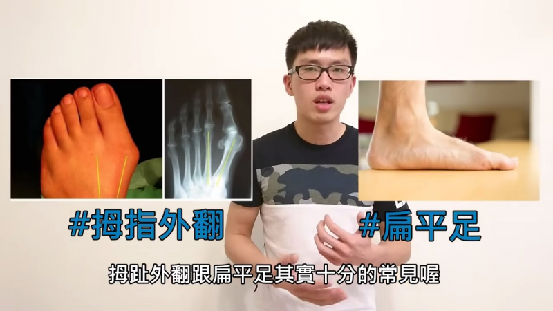 每3个人就有1个有的脚底2大问题？！拇指外翻和扁平足｜阿舟物理治疗