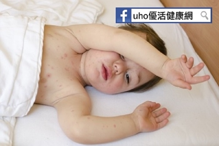 別小看皮膚冒紅點，新生兒竟患了這個疾病　醫師：與母親自體免疫抗體有關