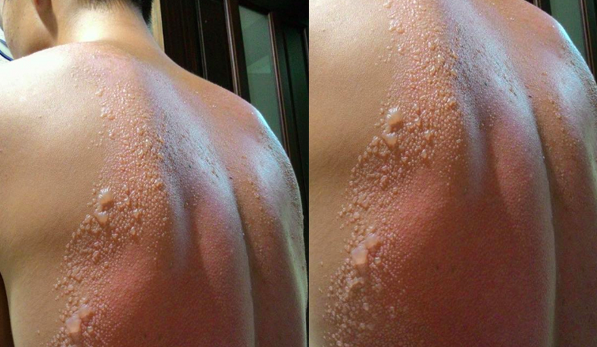 驚！男子「曬太陽2小時」竟嚴重燙傷！背後「起水泡」的樣子太可怕了...