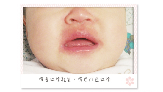 郭和昌醫師告訴你：孩子高燒要當心，別讓川崎症傷了寶貝的心臟！