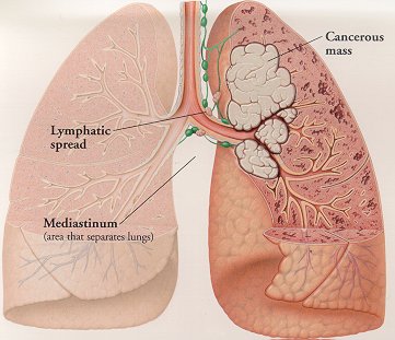 肺癌治療與免疫療法