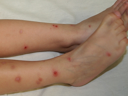 明明只有被蚊子叮一口，怎麼整隻腳都是一顆一顆的紅豆冰？