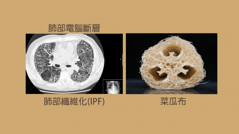 |菜瓜布肺|罕病「肺纖維化」肺部斷層如菜瓜布|