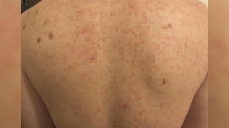 「延遲性過敏」！50歲男接種莫德納　3天後紅疹